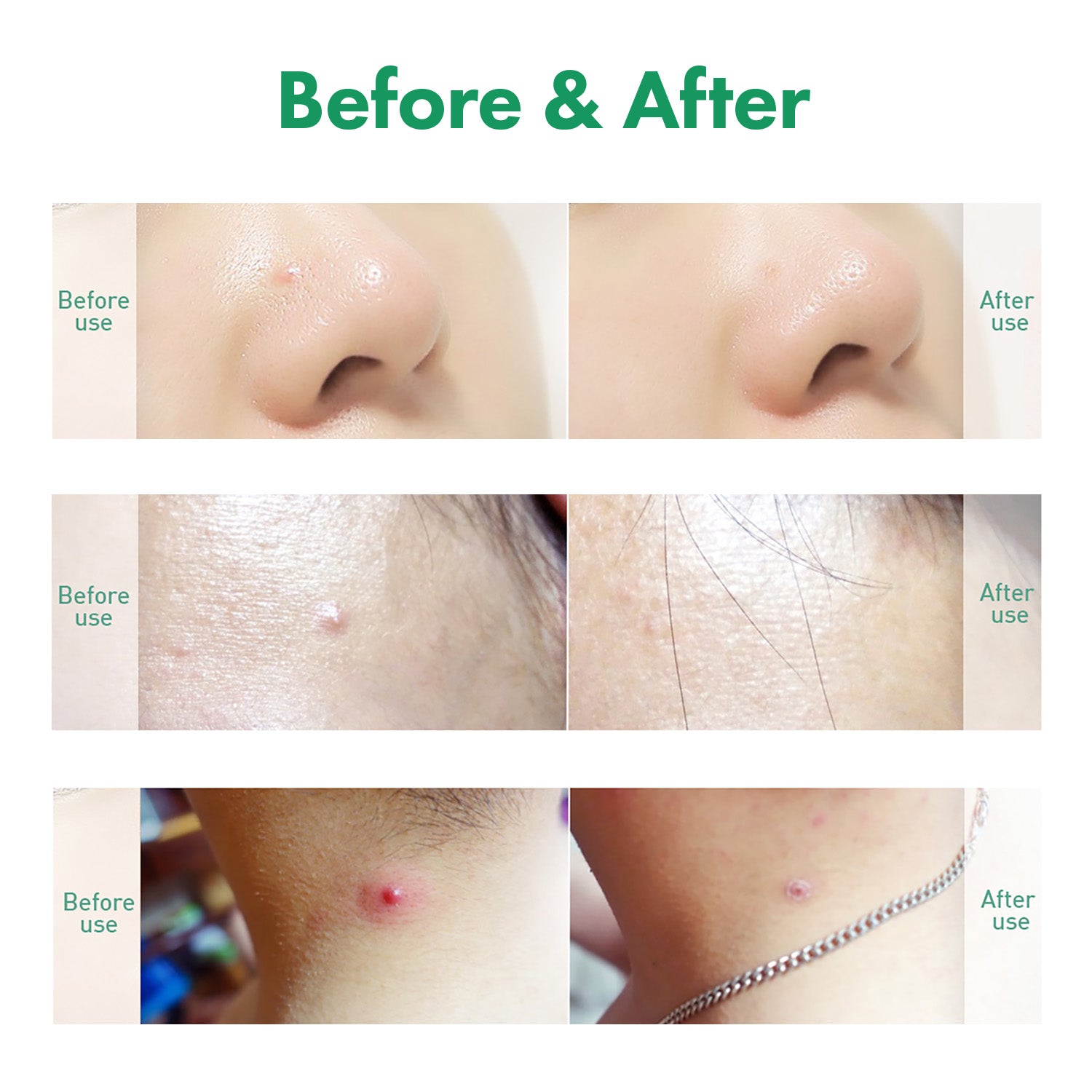 Trouble Care Microcone Acne Patch